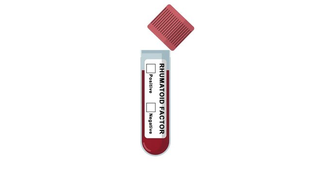 Animated rheumatoid factor test tube showing a negative result with a tick box. RF test for arthritis or autoimmune disease diagnosing concept in a medical laboratory - Powered by Adobe