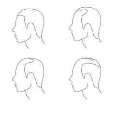stage of baldness, bald head illustration receding hairline  alopecia man 