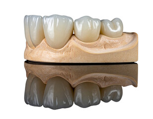 Angled Perspective of Overlapping Teeth, Highlighting Tooth-on-Tooth Formation, Transparent Background