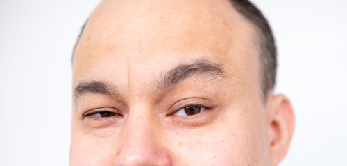 Obraz premium Closeup portrait part man's face 30-35 years old with brown eyes and shaved head, male baldness and growing need professional hair restoration, natural skin texture, intensity glance, human forehead