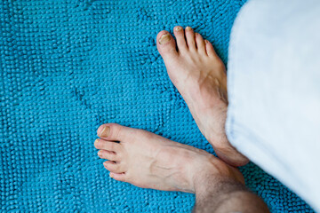 Detalhe de p&eacute;s descal&ccedil;os com unhas infetadas com micose, fungos.