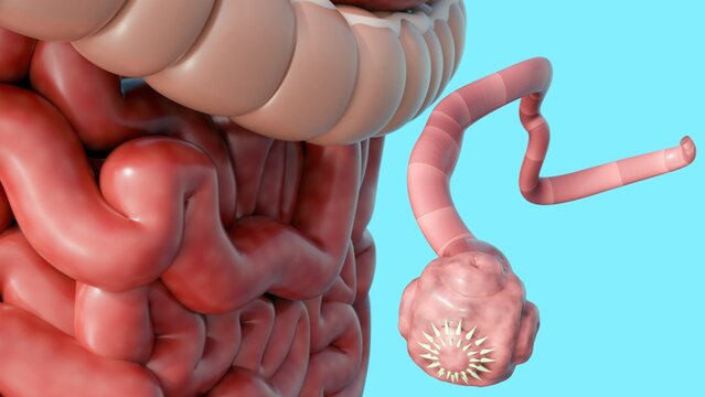 A 3d illustration of the Taenia tapeworm infection within the small intestine.