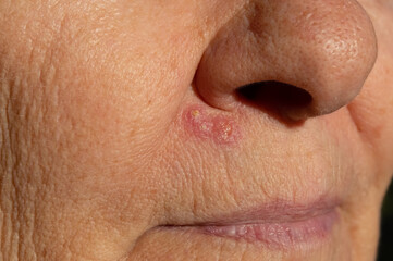 Close-up of a herpes rash, a purulent inflammation on the face