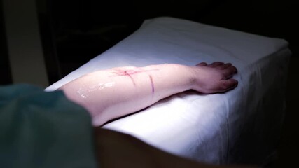 Medical professionals are conducting a surgical procedure on a patient's arm, meticulously working to ensure a successful outcome in the operating room