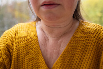 Womans collar bones and décolletage, examines wrinkles on skin, freckles and moles, age-related skin changes, care anti-aging procedures