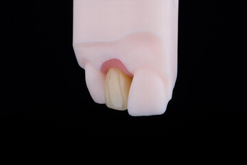 Mirror copy of lateral maxillary incisor, zirconia crown on titanium abutment fixed on printed model