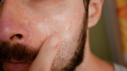 Man Applies Acne or Rosacea Topical Cream