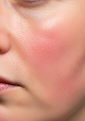 Rosacea with Facial Redness and Broken Capillaries