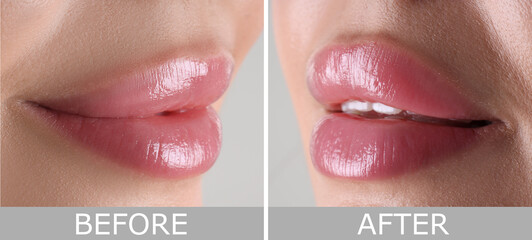 Lip augmentation, collage. Woman showing her lips before and after cosmetic procedure, closeup