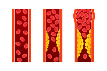 Illustration normal blood vessels vs arteries with cholesterol plaque.