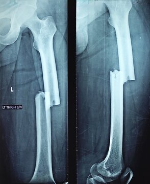 Left femoral-shaft fracture &mdash; displaced, comminuted segmental fracture; AP and lateral radiograph, shaft of femur fracture 