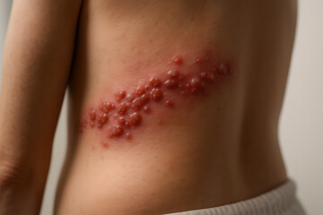 Photorealistic 3D medical scene of shingles (herpes zoster), adult torso turned away from camera (no face visible), unilateral dermatomal vesicular rash along right thoracic flank, mild erythema