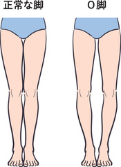正常な脚とO脚のセット