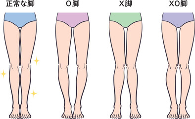 正常な脚とX脚・O脚・XO脚のセット