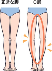 正常な脚とO脚の比較イラスト（補助線あり）