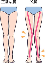 正常な脚とX脚の比較イラスト（補助線あり）