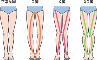 正常な脚とX脚・O脚・XO脚の比較イラスト
（補助線あり）