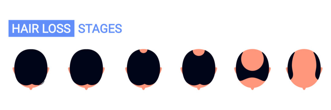 Top view of male hair loss stages from full hair to baldness. Androgenetic alopecia and male pattern baldness progression chart. Isolated vector illustration in cartoon style