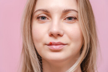 Naklejka premium Closeup on herpes cold sore on mouth of young woman with pink background. Herpes blisters