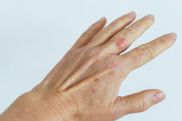 woman hand with scratched finger, wound