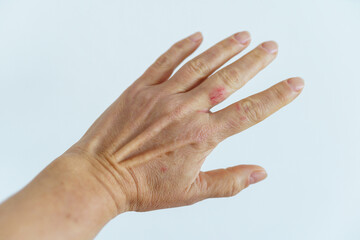 woman hand with scratched finger, wound