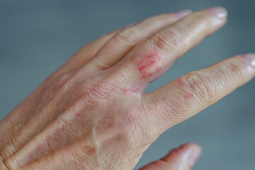 woman hand with scratched finger, wound