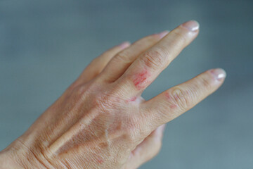 woman hand with scratched finger, wound