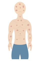 Fototapeta premium Rash on a human body. The patient's face and body are covered with pink spots. The muscular man is sad. Color vector illustration. Isolated on white background. Flat style. Medical theme. 