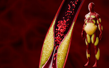 Human Body Showing Visceral and Subcutaneous Fat with Atherosclerosis Artery Blockage Medical Anatomy 3D Rendering