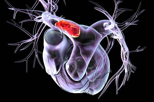 Right pulmonary embolism, 3D illustration.