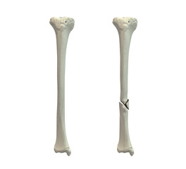 Normal tibia bone and tibia with shaft fracture, 3D illustration