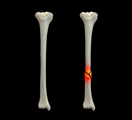 Normal tibia bone and tibia with shaft fracture, 3D illustration