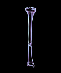 Tibia shaft fracture, 3D illustration. Shows a break in the tibial shaft, commonly caused by trauma. Clinically important for orthopedic assessment, surgical fixation, and fracture classification.