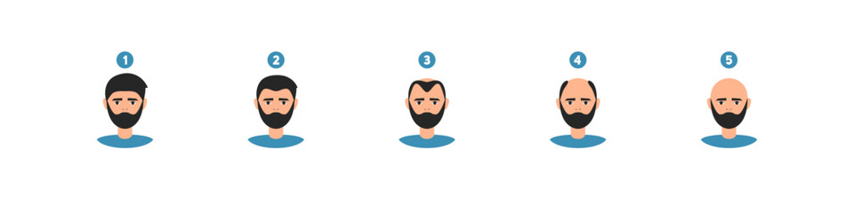 Hair loss stages. Alopecia problem. Baldness vector set. Male head scalp