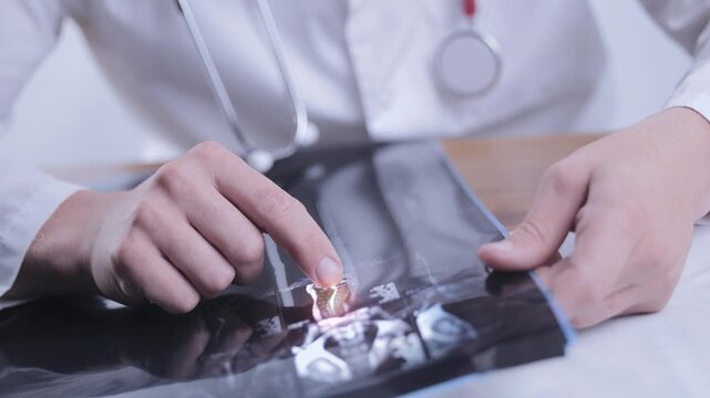 Caucasian male doctor neurosurgeon looking mri scan of spinal column showing disc protrusion, Cause of pinched sciatic nerve in leg buttock.