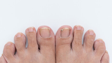 Close-up view of human feet with unpolished toenails on a clean white background, showcasing...