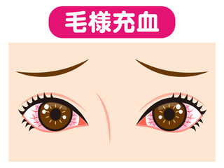 	毛様充血で充血した両目のイラスト素材