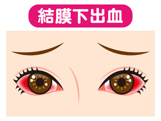 	結膜下出血で充血した両目のイラスト素材