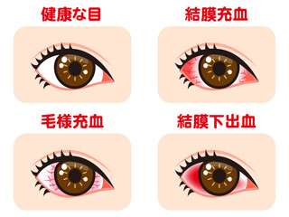 充血する片目の図解イラスト素材セット