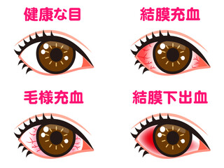 充血する片目の図解イラスト素材セット2