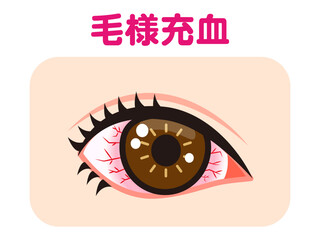 	毛様充血で充血した片目のイラスト素材