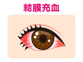 	結膜充血で充血した片目のイラスト素材