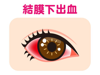 	結膜下出血で充血した片目のイラスト素材
