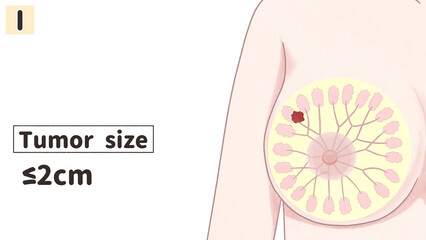 Breast cancer Stage 1 Medical diagram Transparent PNG