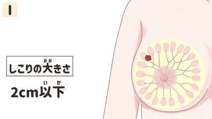 Breast cancer Stage 1 Medical diagram Transparent PNG
