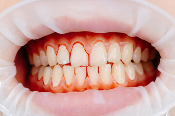 Dentist examining patient teeth using cheek retractor during dental procedure