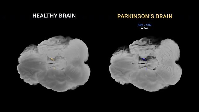Parkinson&rsquo;s Disease Brain Comparison Axial View Dopaminergic Dysfunction