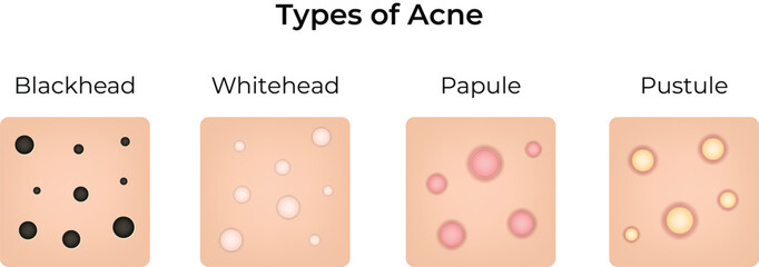 Visual Guide to Common Acne Types Vector Illustration