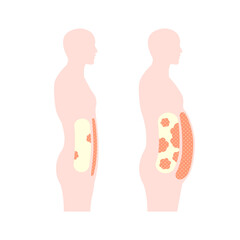 Human silhouette illustration of visceral fat and subcutaneous fat