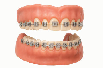3d realistic dental model showing upper and lower human teeth with metal braces and gum tissue isolated on white background used for orthodontic, medical, and dental care education illustration.